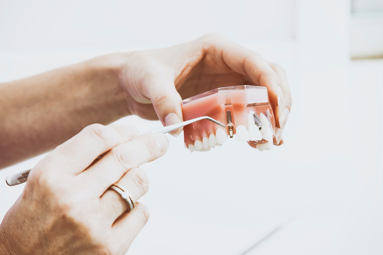 Proteze za zube Zubne proteze