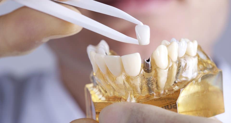 Stomatoloska zubna protetika Krunice i mostovi za zube Zubne proteze